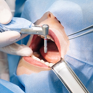  Dental implant surgery is the second step in the dental implant treatment process