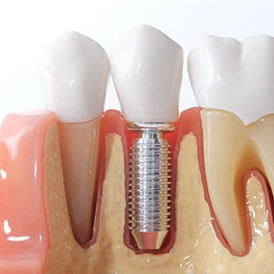 Osseointegration is where your dental implant permanently fuses with the jawbone