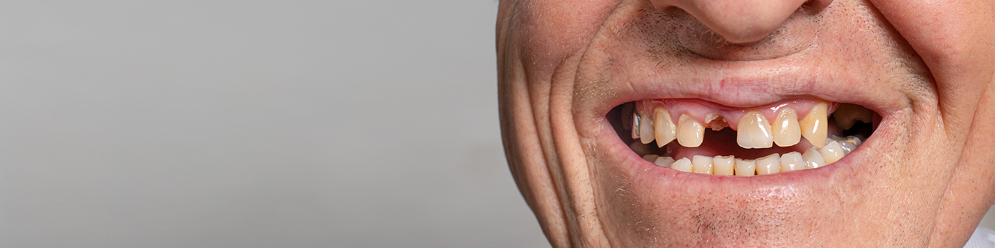 Close up of man with missing tooth in Bradford