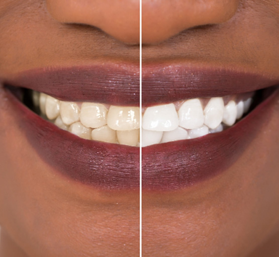 Patient's smile before and after teeth whitening