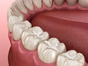 Digital rendering of tooth-colored fillings.