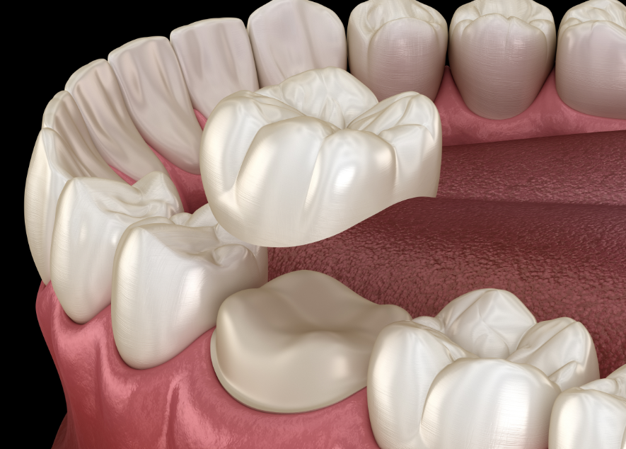 3D image of a dental crown